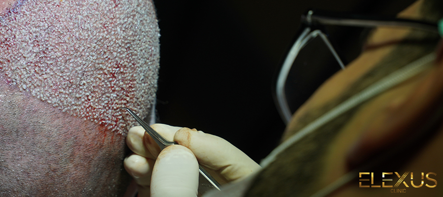¿Cómo se realiza el trasplante de cabello en Turquía?