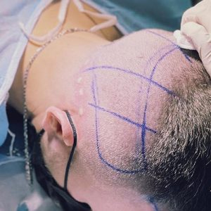 ¿Qué es el trasplante de cabello sin afeitar y cómo se realiza?