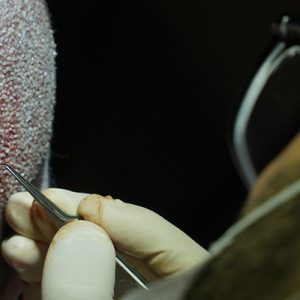 Come viene effettuato il trapianto di capelli in Turchia?