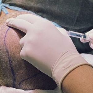 Come prendersi cura dei capelli dopo il trapianto di capelli?
