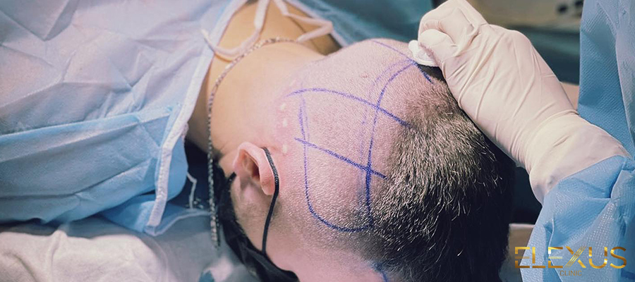 Cos’è il trapianto di capelli non rasati e come viene eseguito?