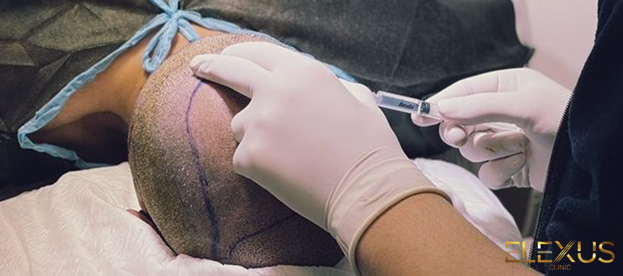 How to Care for Hair After Hair Transplantation?